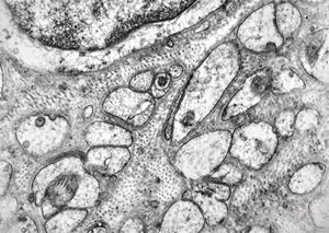 M, 58y. | neurofibroma M, 58y. | neurofibroma